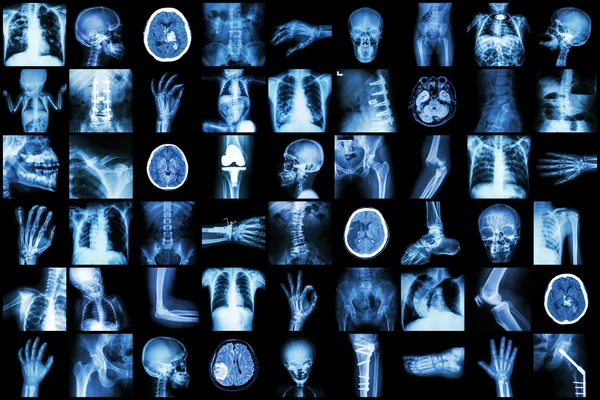 X-ray multiple part of adult and child and Disease ( Pulmonary tuberculosis Stroke kidney stone osteoarthritis bone fracture bowel obstruction spondylosis spondylolisthesis scoliosis brain tumor etc) — Stock Photo, Image