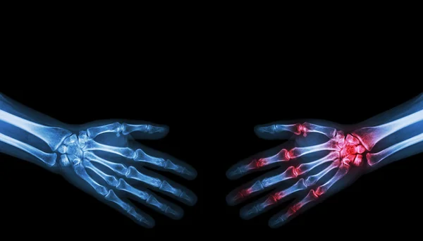 X-ray persona normale sta stringendo la mano con l'artrite persona mano — Foto Stock