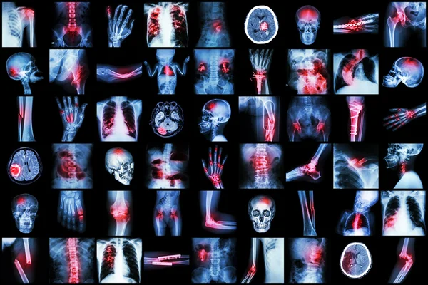 Radiografia doença múltipla de criança e adulto (acidente vascular cerebral, artrite, fratura, tuberculose, tumor cerebral, obstrução intestinal, pedra renal, espondilose, espondilolistese, joelho osteoartrite, etc ) — Fotografia de Stock