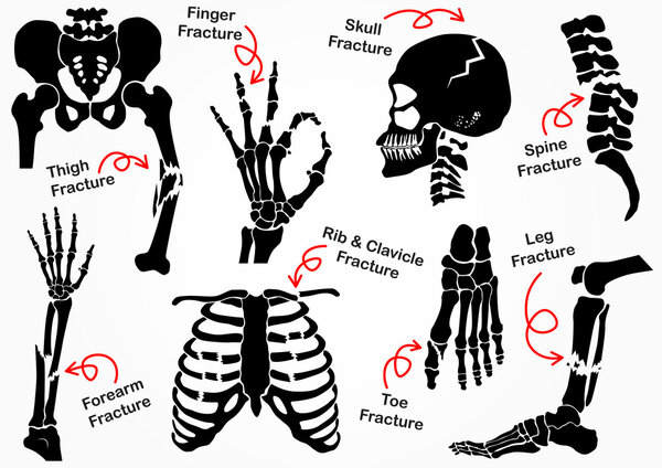 Set Bone Fracture Icon ( Pelvic , Hip , Thigh ( femur ) , Hand , Wrist , Finger , Skull , Face , Vertebra , Arm , Elbow , Thorax , Foot , Heel , Leg ) black & white design ( health care concept )