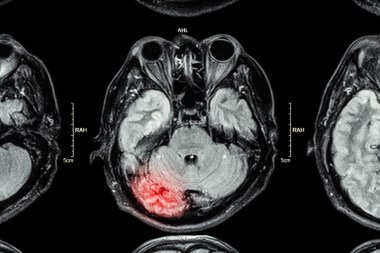 Beyin MRI: beyin yaralanması