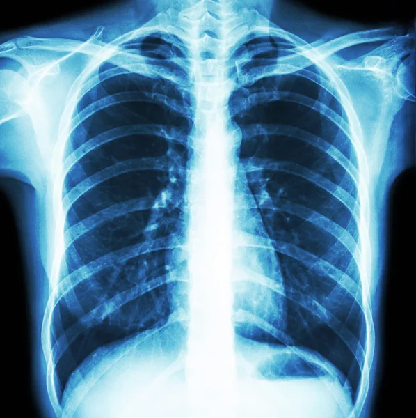 Normal human's chest — Stock Photo, Image