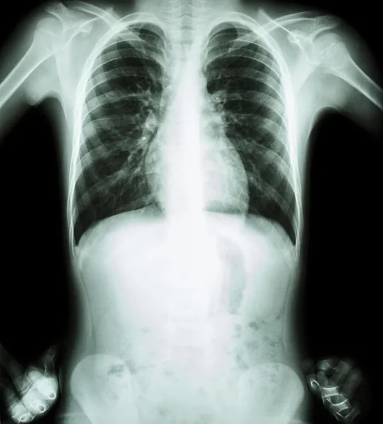 X-ray chest ( akimbo position ) ( front view ) — Stock Photo, Image