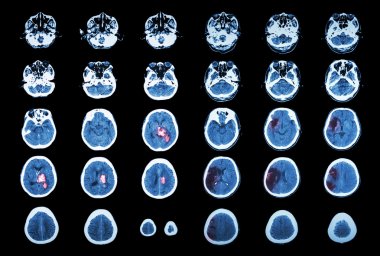 Hemorajik İnme ve İskemik İnme. Beyin tomografisi : intraserebral kanama ( 3 sol kolon , serebral enfarktüs ( 3 sağ kolon )) ( Tıp ve Bilim arka plan )