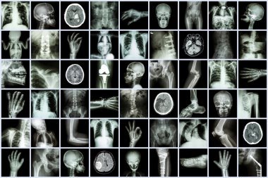 Yetişkin ve çocuk ve hastalıkları (akciğer tüberkülozu felç böbrek taşı osteoartrit kemik kırığı bağırsak tıkanıklığı spondiloz spondilolistezis skolyoz beyin tümörü vb çoklu bölüm x-ışını)