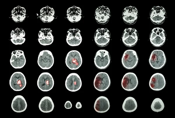 AVC hémorragique et AVC ischémique. CT scan du cerveau : hémorragie intracérébrale (3 colonne gauche, infarctus cérébral (3 colonne droite)) (Contexte médical et scientifique  ) — Photo