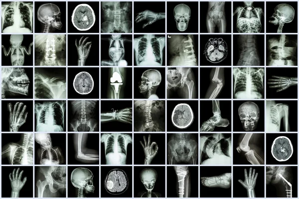 Radiografía parte múltiple de adulto y niño y enfermedad (tuberculosis pulmonar accidente cerebrovascular cálculos renales osteoartritis fractura ósea obstrucción intestinal espondilosis espondilolistesis escoliosis tumor cerebral, etc. ) —  Fotos de Stock