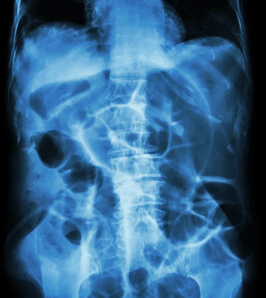 Obstrucción intestinal (posición supina del abdomen por rayos X: intestino grueso) — Foto de Stock