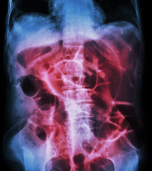 Obstrucción intestinal (posición supina del abdomen por rayos X: intestino grueso) — Foto de Stock