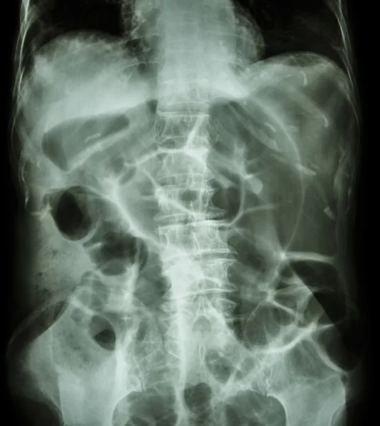 Obstrução intestinal (posição supina do abdômen de raios-X: intestino grosso — Fotografia de Stock