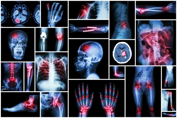 X-ray wielu chorób (udaru mózgu (Cva) złamania, zwichnięcia barku, Niedrożność jelit, Reumatoidalne zapalenie stawów, dna moczanowa, choroba zwyrodnieniowa stawów kolanowych, chirurgii ortopedycznej, płuc gruźlicy (Tb), itp) — Zdjęcie stockowe