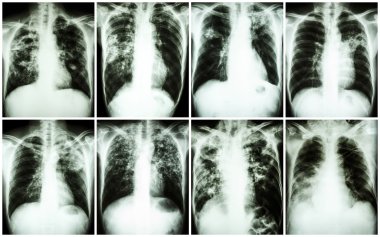 Akciğer tüberkülozu koleksiyonu. Göğüs röntgeni: düzensiz infiltrasyon, interstisyel infiltrasyon, alveoler infiltrasyon, kavite, fibrozis akciğer Mycobacterium tüberküloz enfeksiyon nedeniyle göstermek