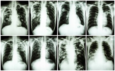 Pulmonary Tuberculosis Collection .  Chest X-ray : show patchy infiltration , interstitial infiltration , alveolar infiltration , cavity , fibrosis at lung due to Mycobacterium tuberculosis infection clipart