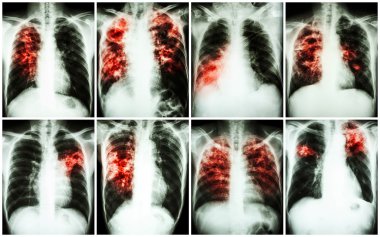 Akciğer tüberkülozu koleksiyonu. Göğüs röntgeni: düzensiz infiltrasyon, interstisyel infiltrasyon, alveoler infiltrasyon, kavite, fibrozis akciğer Mycobacterium tüberküloz enfeksiyon nedeniyle göstermek