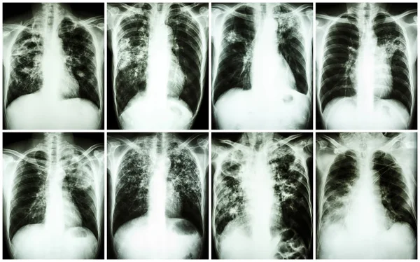 Coleção de Tuberculose Pulmonar. Radiografia de tórax: mostra infiltração irregular, infiltração intersticial, infiltração alveolar, cavidade, fibrose pulmonar devido à infecção por Mycobacterium tuberculosis — Fotografia de Stock