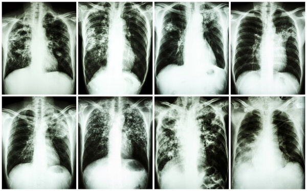 Pulmonary Tuberculosis Collection .  Chest X-ray : show patchy infiltration , interstitial infiltration , alveolar infiltration , cavity , fibrosis at lung due to Mycobacterium tuberculosis infection