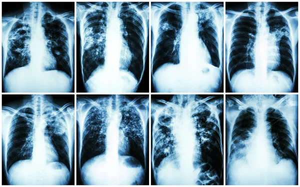 Collection sur la tuberculose pulmonaire. Radiographie pulmonaire : infiltration inégale, infiltration interstitielle, infiltration alvéolaire, cavité, fibrose pulmonaire due à une infection à Mycobacterium tuberculosis — Photo