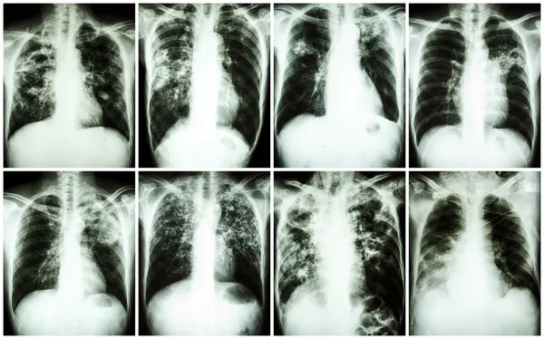肺結核のコレクションです。胸部 x 線: 結核菌感染による肺での斑状の浸潤、間質浸潤、肺胞浸潤、キャビティ、線維化を表示します。 — ストック写真