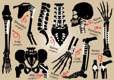 Ortopedik cerrahi Koleksiyonu ( Plaka ve vida ile iç fiksasyon )( kafatası, baş, boyun, omurga, sakrum, kol, önkol, el, dirsek, omuz, pelvik , uyluk , kalça , diz , bacak , ayak )