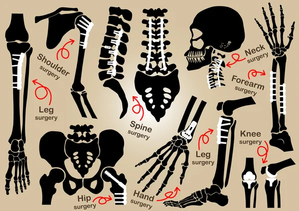 Coleção de cirurgia ortopédica (fixação interna por placa e parafuso) (crânio, cabeça, pescoço, coluna vertebral, sacro, braço, antebraço, mão, cotovelo, ombro, pélvica, coxa, quadril, joelho, perna, pé  ) —  Vetores de Stock