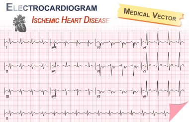 Elektrokardiyogram (EKG, Ekg) iskemik kalp hastalığı (miyokard enfarktüsü) ve kalp simgesi anatomisi