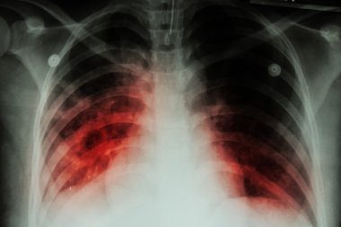 Akciğer tüberkülozu (Tb): Göğüs röntgeni Show'da alveoler infiltrasyon mycobacterium tüberküloz infectionpulmonary tüberküloz (Tb) nedeniyle her iki akciğer: göğüs röntgeni göster alveoler infiltratio