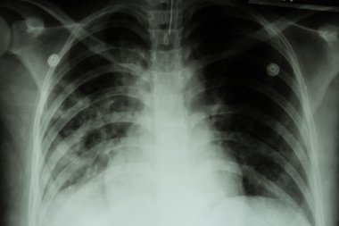 Akciğer tüberkülozu (Tb): Göğüs röntgeni Show'da alveoler infiltrasyon mycobacterium tüberküloz enfeksiyon nedeniyle her iki akciğer