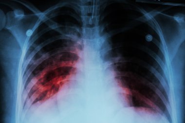 Akciğer tüberkülozu (Tb): Göğüs röntgeni Show'da alveoler infiltrasyon mycobacterium tüberküloz enfeksiyon nedeniyle her iki akciğer