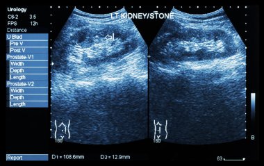 Ultrasonography of kidney : show left kidney stone ( 2 image for compare ) clipart