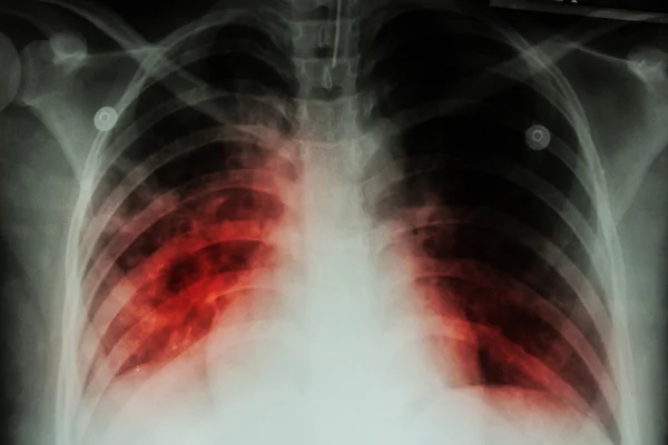 Tuberculose pulmonaire (TB) : Les radiographies pulmonaires montrent une infiltration alvéolaire aux deux poumons due à une infection à mycobactérie tuberculeuseTuberculose pulmonaire (TB) : Les radiographies pulmonaires montrent une infiltratio alvéolaire — Photo