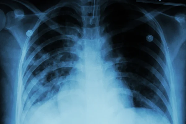 肺结核 (Tb): 胸部 x 光显示肺泡浸润在这两个由于结核杆菌感染的肺 — 图库照片