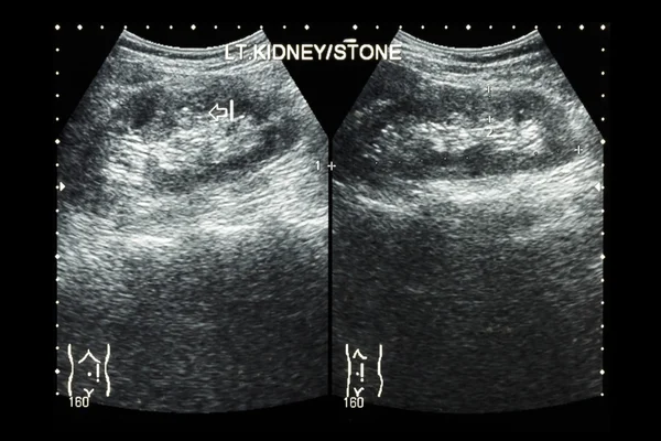 Ultrasonography of kidney : show left kidney stone ( 2 image for compare ) — Stock Photo, Image