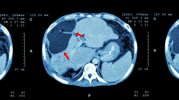 上腹部のCtスキャン : 肝臓で異常な塊を示す (肝臓癌 ) — ストック写真