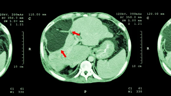 TC de abdômen superior: mostrar massa anormal no fígado (câncer de fígado  ) — Fotografia de Stock