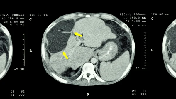 CT-scan van bovenbuik: abnormale massa bij de lever vertonen (leverkanker ) — Stockfoto