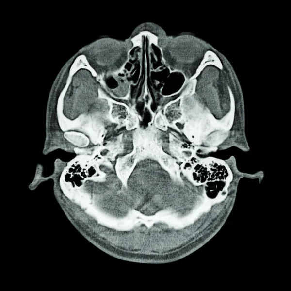 CT scan of brain and base of skull  ( Bone window ) — Stock Photo, Image