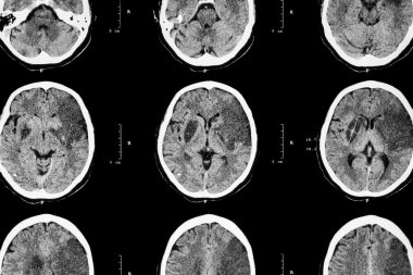 İskemik inme : ( Ct beyin sol frontal serebral enfarktüs göstermek - temporal - parietal lob ) ( sinir sistemi arka plan )