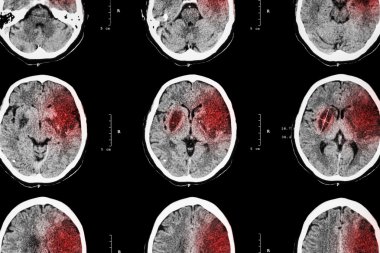 İskemik inme : ( Ct beyin sol frontal serebral enfarktüs göstermek - temporal - parietal lob ) ( sinir sistemi arka plan )