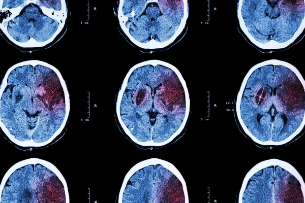 Ισχαιμικό εγκεφαλικό επεισόδιο: (CT του εγκεφάλου εμφανίζουν εγκεφαλικό έμφραγμα στο αριστερό μετωπικό-κροταφικό λοβό) (φόντο του νευρικού συστήματος ) — Φωτογραφία Αρχείου