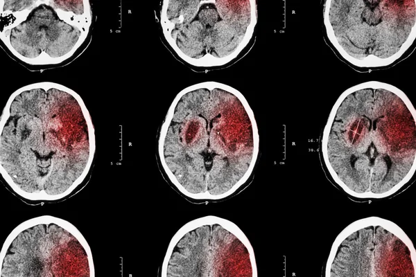 Ischemisk stroke: (CT av hjärnan visar cerebral infarkt vid vänster frontal-temporal-parietalloben) (nervsystemets bakgrund ) — Stockfoto