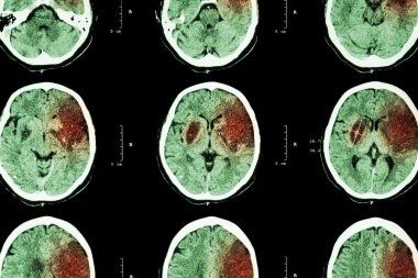 İskemik inme : ( Ct beyin sol frontal serebral enfarktüs göstermek - temporal - parietal lob ) ( sinir sistemi arka plan )