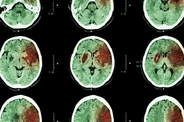 ACV isquémico: (La TC del cerebro muestra infarto cerebral en el lóbulo frontal izquierdo temporal parietal) (fondo del sistema nervioso  ) —  Fotos de Stock