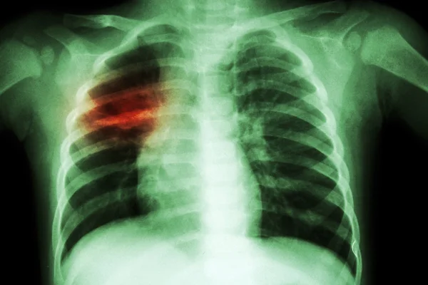 Tuberculosis pulmonar (radiografía de tórax del niño: muestra infiltración irregular en el pulmón medio derecho  ) — Foto de Stock