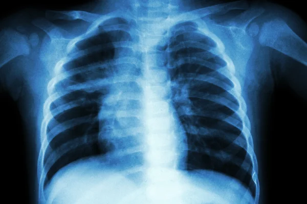 Pulmonary Tuberculosis ( Chest X-ray of child : show patchy infiltration at right middle lung ) — Stock Photo, Image