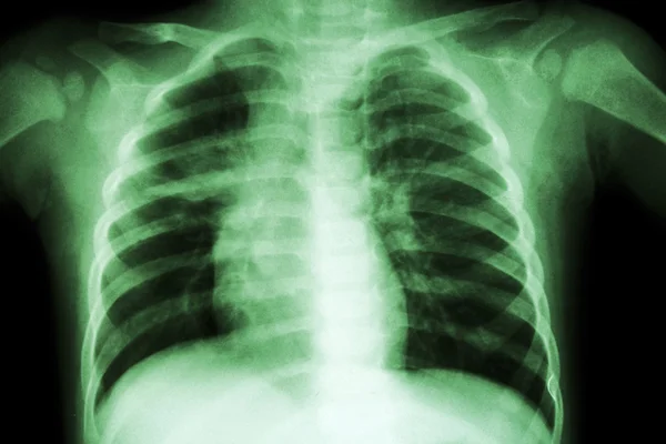 Tuberculose pulmonar (radiografia de tórax da criança: mostrar infiltração irregular no pulmão médio direito  ) — Fotografia de Stock