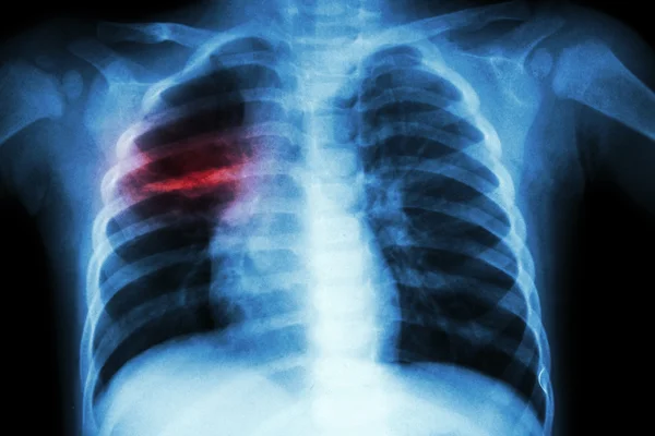 Tuberculose pulmonaire (Radiographie pulmonaire de l'enfant : infiltration inégale au poumon moyen droit  ) — Photo