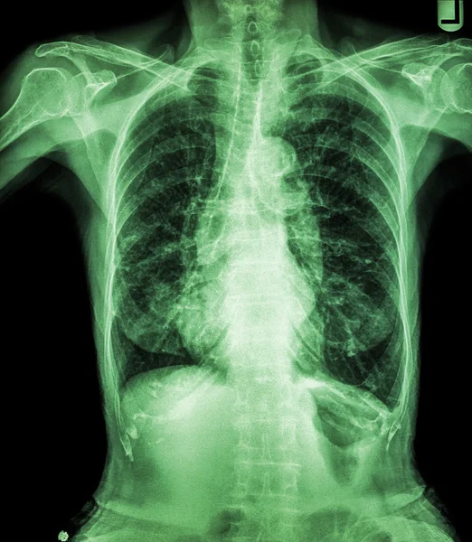 老年患者胸部X射线（肋骨钙化、气管、支气管 ) — 图库照片
