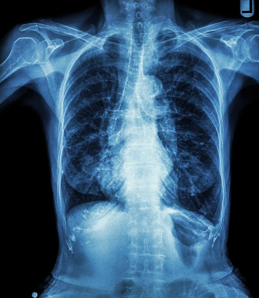 Chest X-ray of old patient ( calcification at rib , trachea , bronchus ) — Stock Photo, Image
