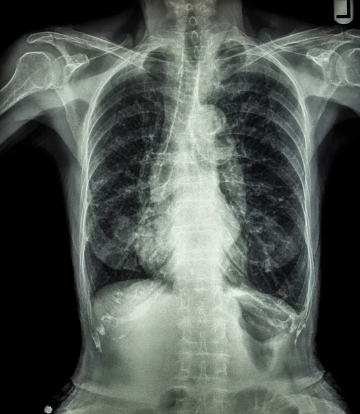 Radiographie thoracique du patient âgé (calcification des côtes, trachée, bronches)  ) — Photo