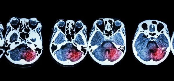 Beroerte (CT-scan van de hersenen en de basis van de schedel en beroerte ) — Stockfoto